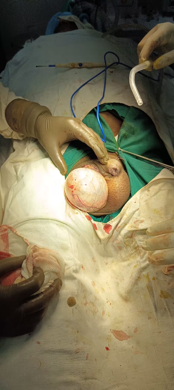 Hydrocele Surgery