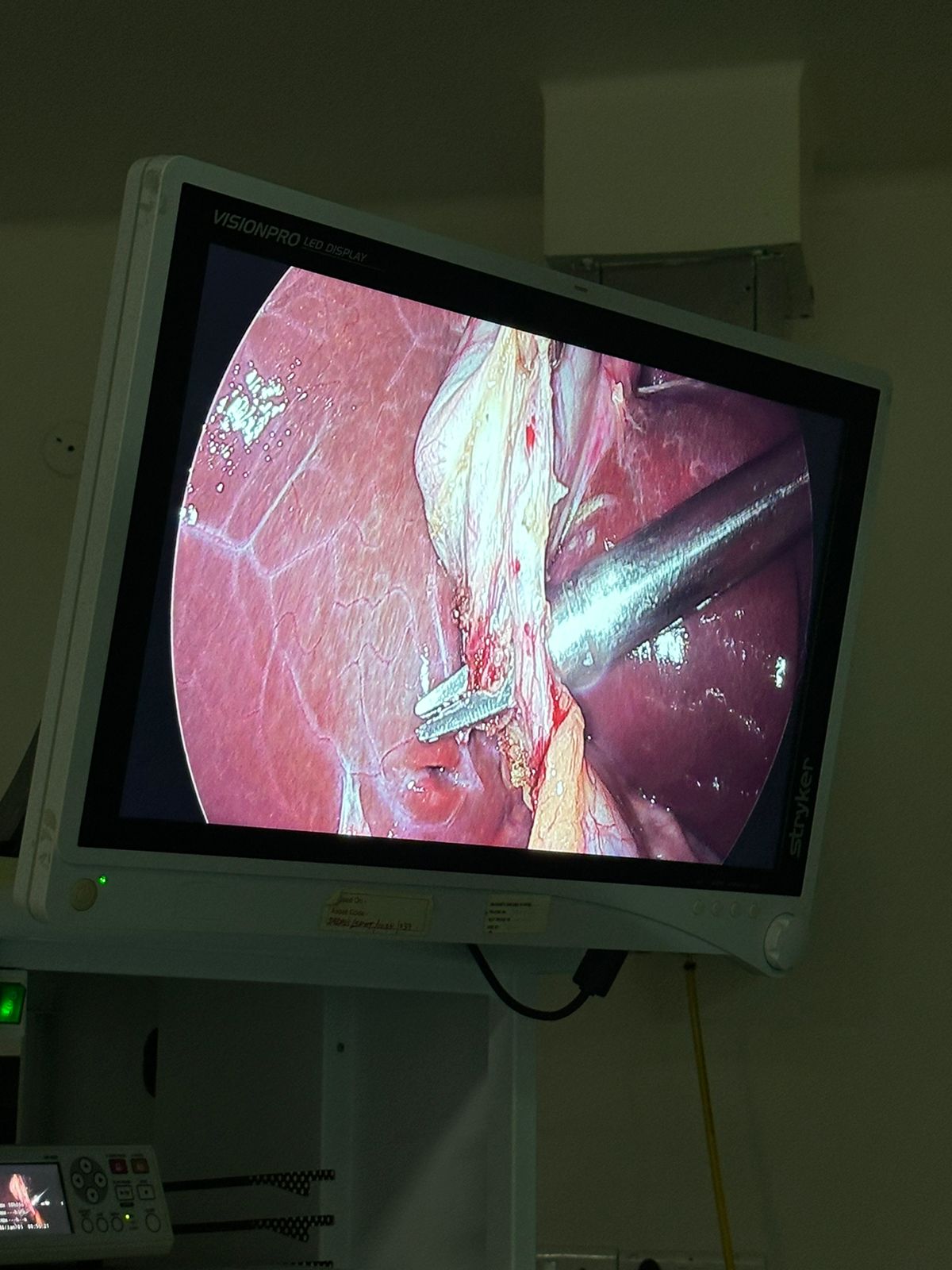 Laparoscopic Gallbladder Surgery