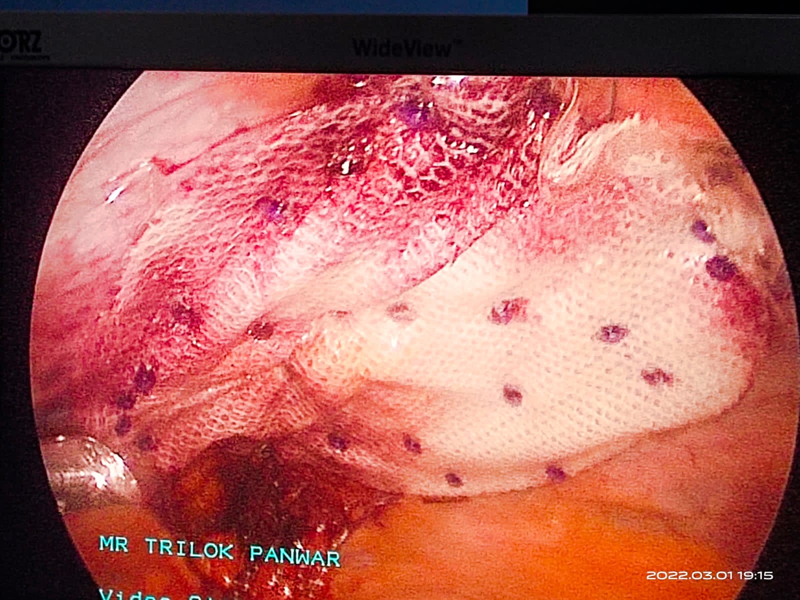 Laparoscopic Mesh Hernioplasty