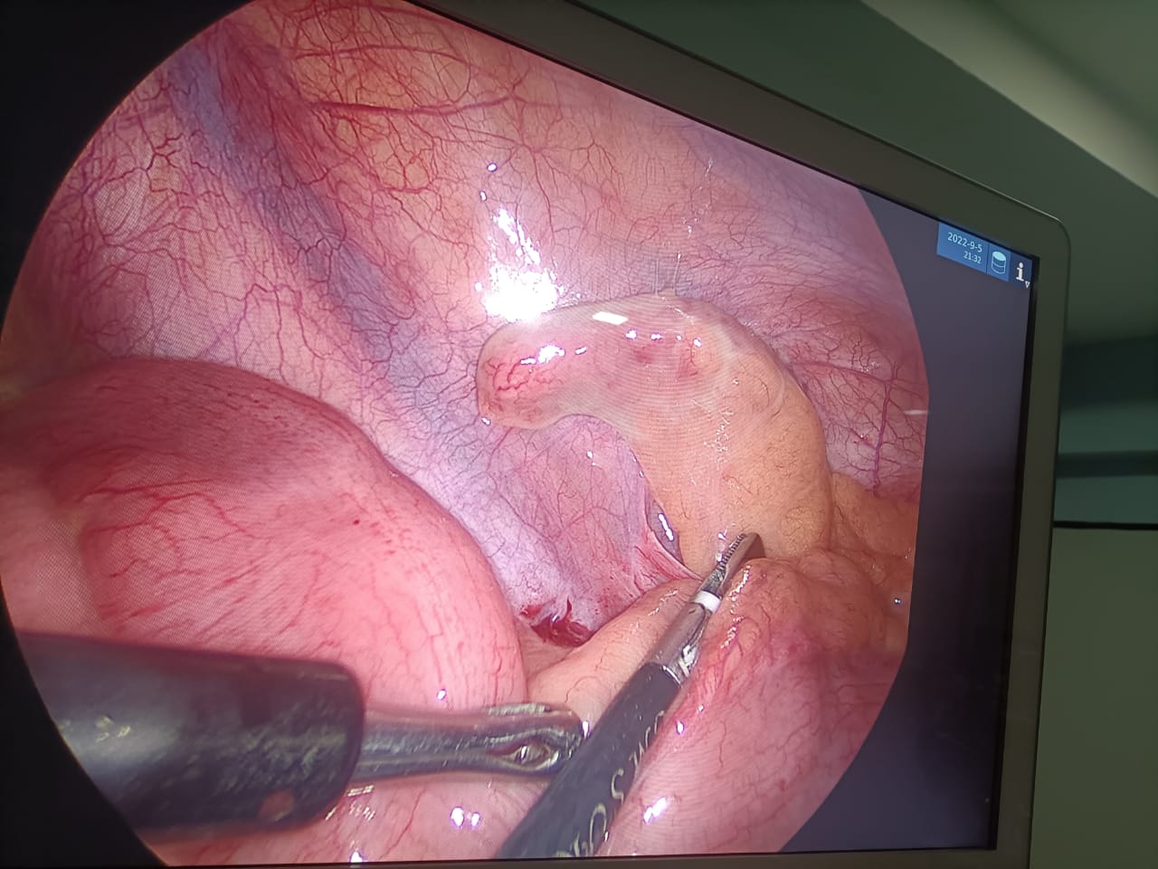 Laparoscopic Appendix Surgery
