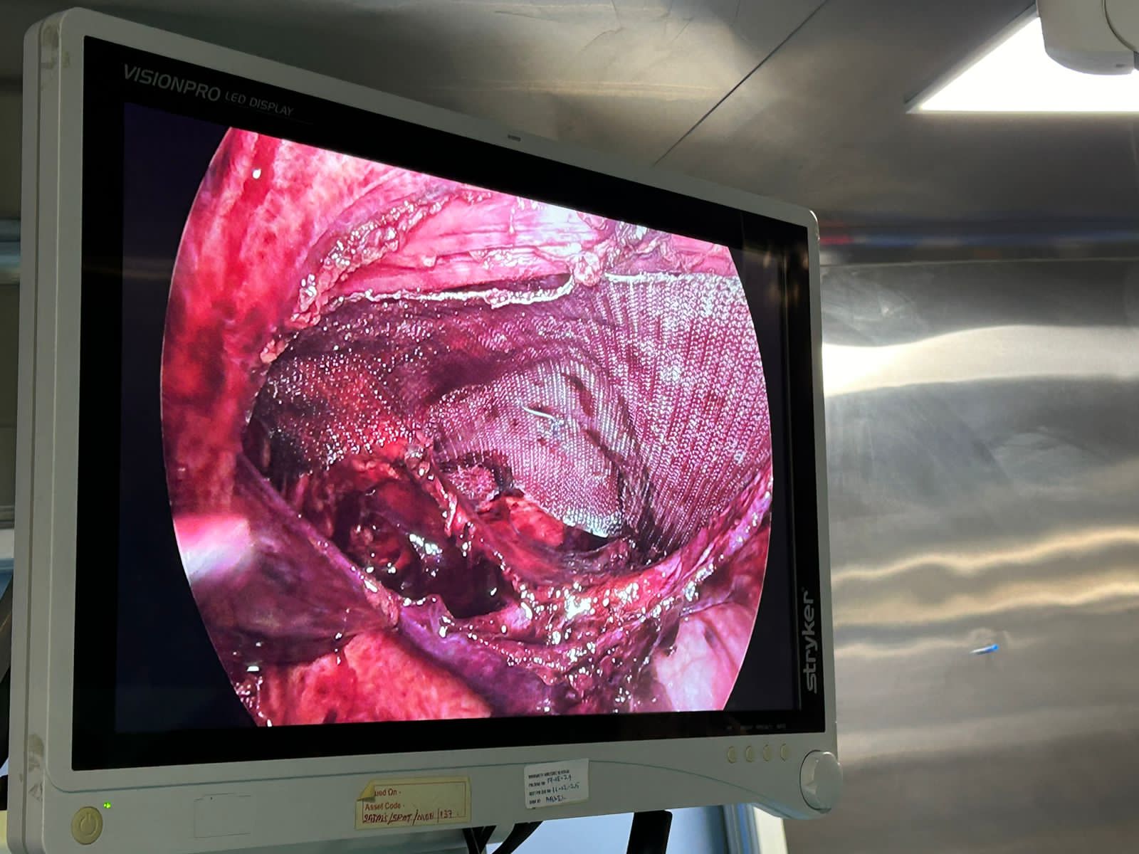 Laparoscopic Inguinal Hernia Surgery