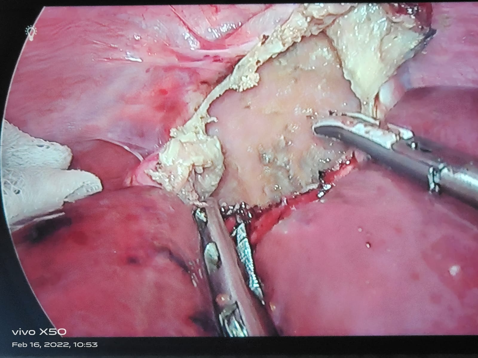 Laparoscopic Hydatid Surgery