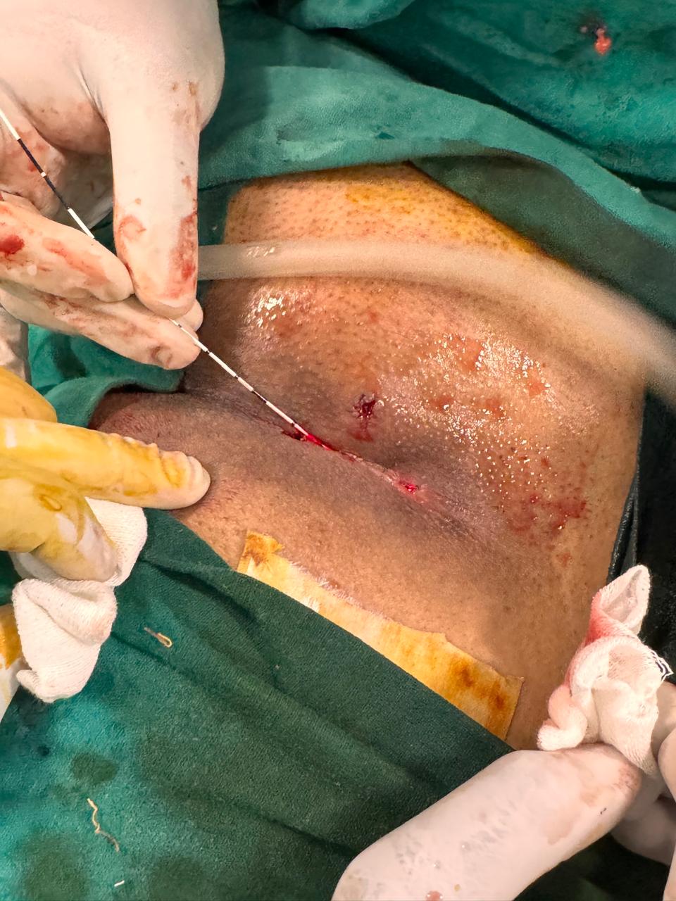 Laser Pilonidal Surgery