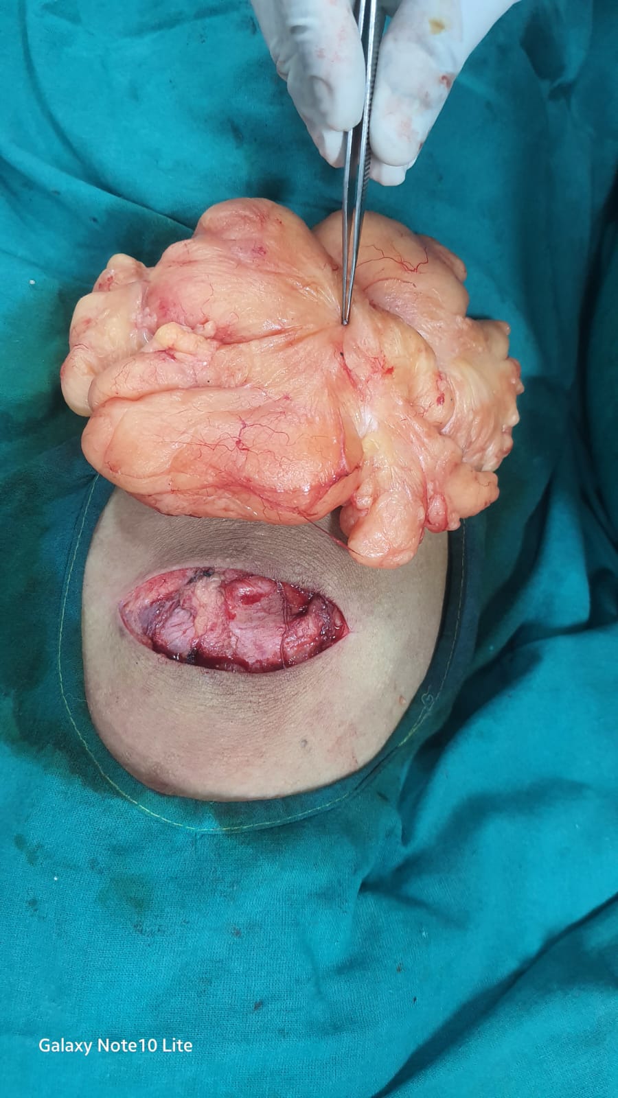 Lipoma Removal Surgery