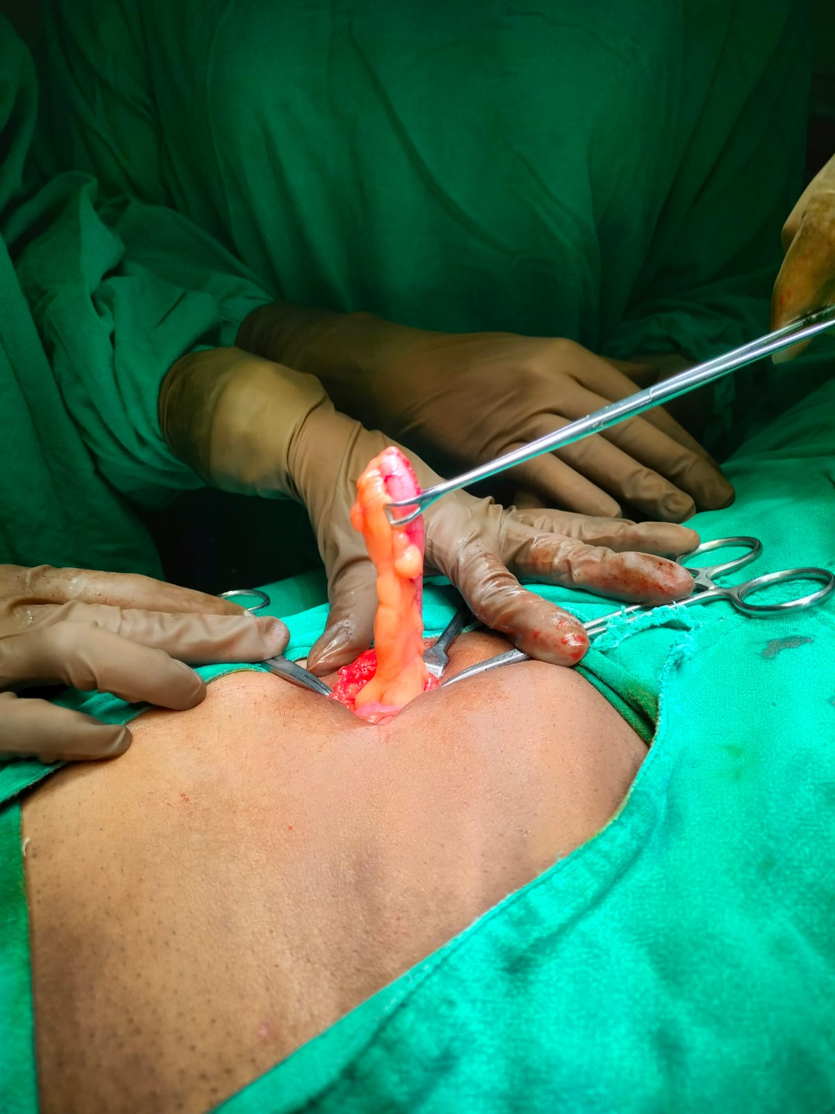 Open Appendix Surgery
