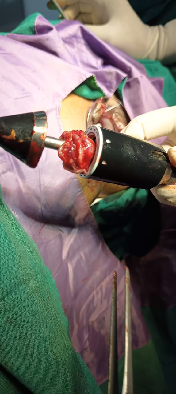 Stapler Hemorrhoid Surgery