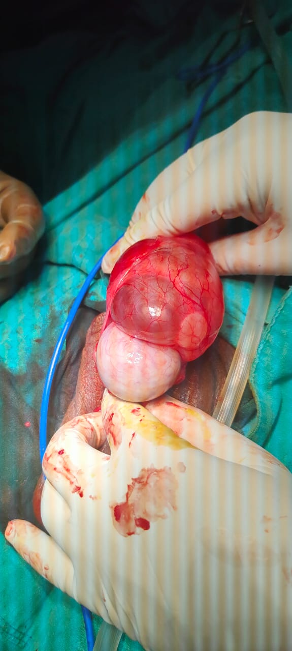 Testis Surgery